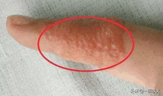 夏天宝宝汗疱疹怎么办