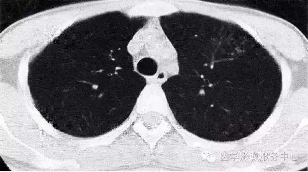 如何判断腺病毒肺炎