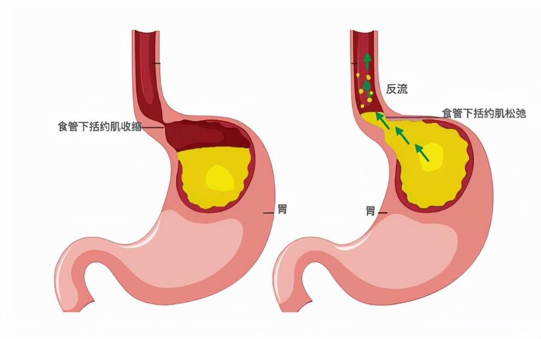 胃酸反流可以多喝水吗喝水过多有什么危害