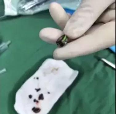 孩子身上发出阵阵臭味，一看这里都坏死了，这辈子都受影响！