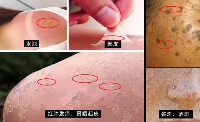 小孩晒出水泡了怎么办