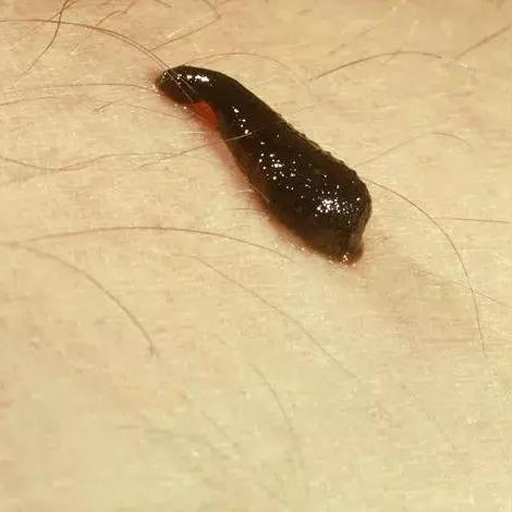 杭州市三去痘痘的相关长尾关键词有哪些