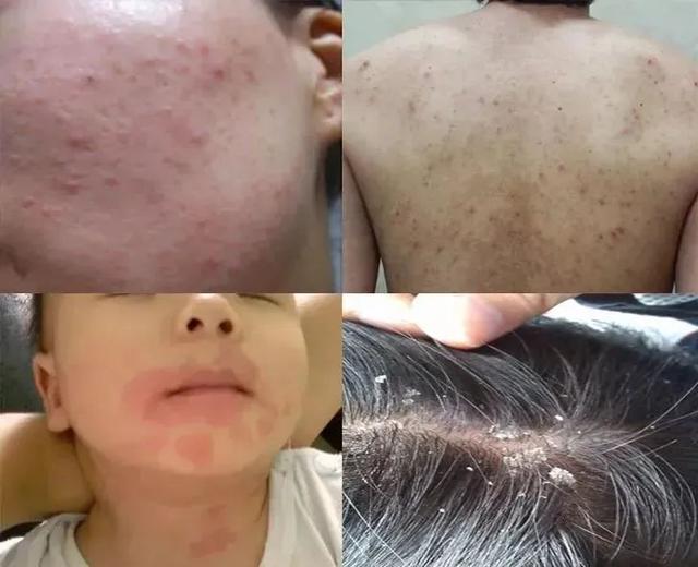 睫毛上有螨虫怎么回事