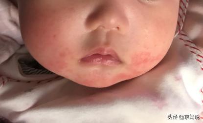 口水疹与湿疹的区别图(宝宝身上起旮瘩爆皮刚开始就脖子下面有)