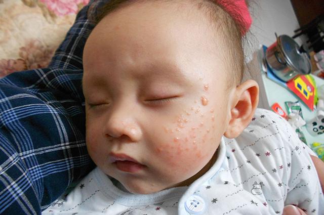 宝宝湿疹为什么不能吃鸡蛋
