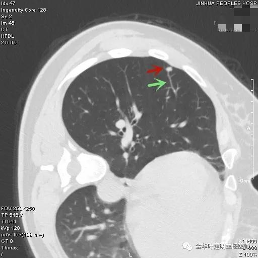 怎么分辨肺结节是良性还是恶性 怎么分辨肺结节是良性还是恶性
