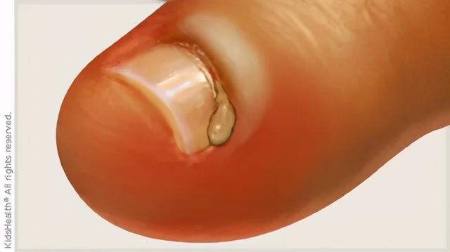 剪指甲剪太进去了痛怎么办 剪指甲剪太进去了痛怎么办