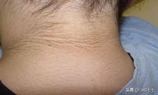孩子身材胖脖子黑容易得糖尿病是真的吗