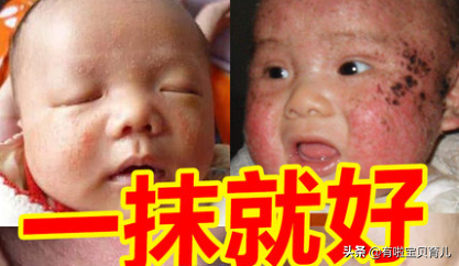 春季宝宝湿疹常见的几个原因