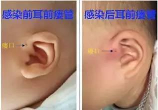 趁休息时间带孩子去医院掏耳朵