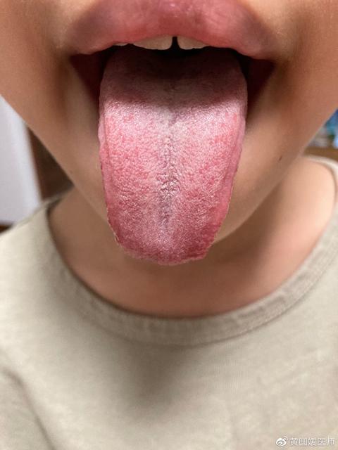 孩子反复咳嗽该怎么办