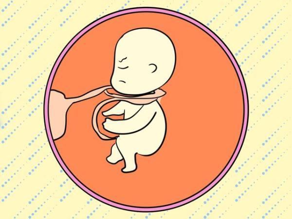 成胎儿绕颈原因是什么