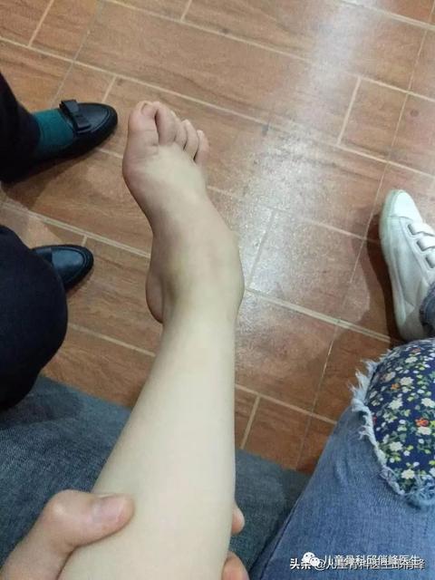 宝宝足内翻怎么判断