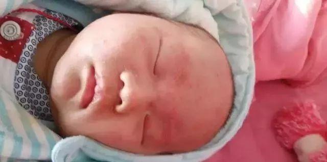 宝宝湿疹反复不好是怎么回事