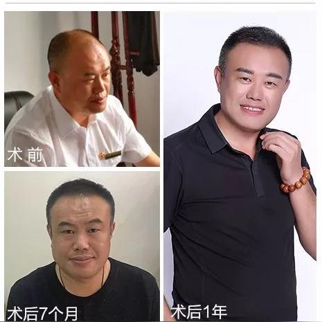 哈尔滨植发论坛相关长尾关键词有哪些