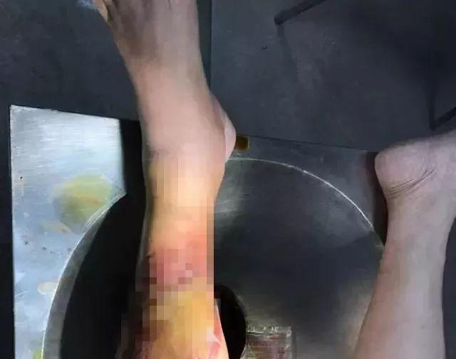 村民被红火蚁咬后休克怎么回事 村民被红火蚁咬后休克怎么回事