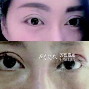 济南双眼皮咨询相关长尾关键词有哪些