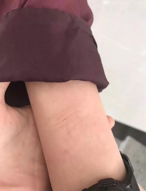 发作性睡病是什么原因引起的