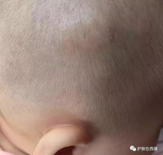 尿布性皮炎的预防和护理方法 尿布性皮炎的预防和护理方法