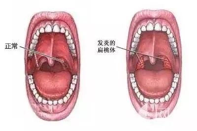扁桃体大就一定是扁桃体炎吗