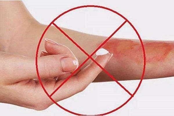 孩子烫伤后抹牙膏效果好吗