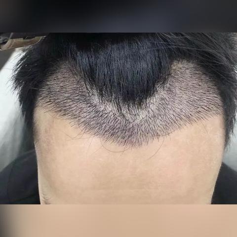 合肥植发医院有哪些相关长尾关键词有哪些