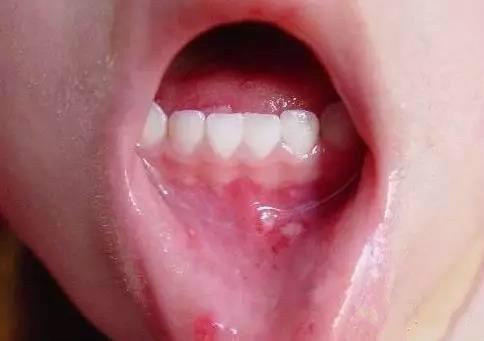 手足口病脸上会起疹子吗