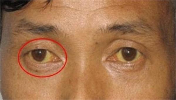 准妈妈如何及早发现肝炎