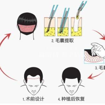合肥植发的医院哪家好相关长尾关键词有哪些
