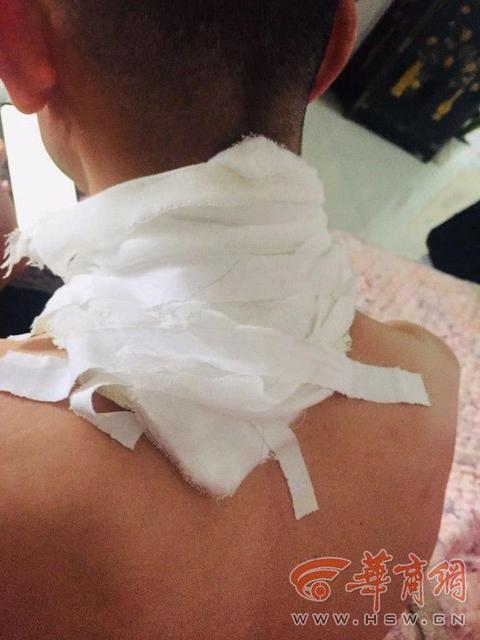 孩子烫伤后可以用酒精消毒吗