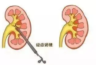 引流管不通畅怎么处理 怎么检查引流管通畅