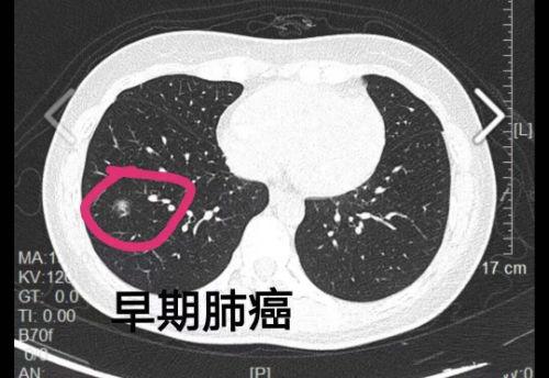 新冠肺炎治愈后会有后遗症吗