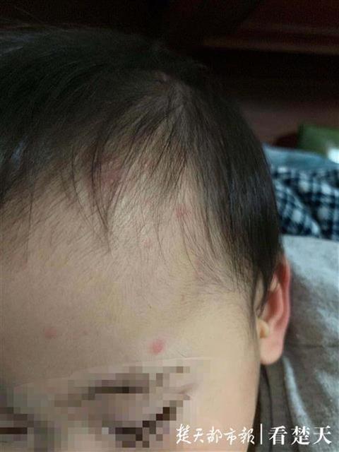 宝宝会将水痘传染给母亲吗 宝宝会将水痘传染给母亲吗