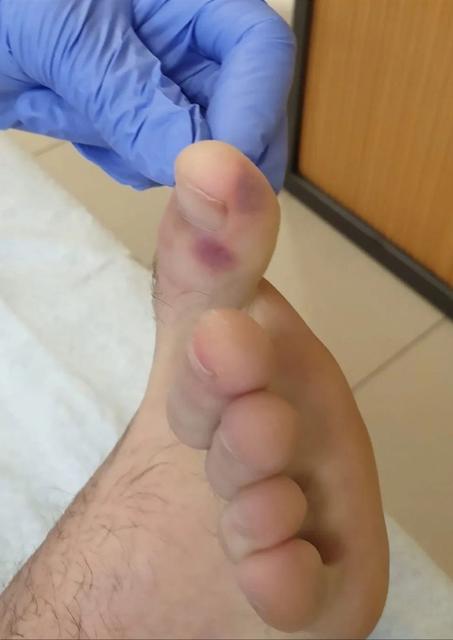 无症状感染者是怎么发现的