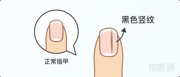 宝宝指甲上有白色的横线怎么办