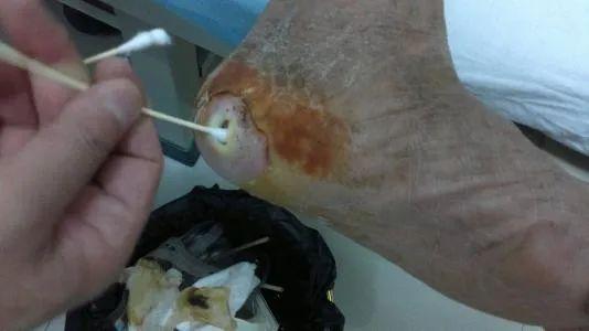 正常人为什么会得糖尿病