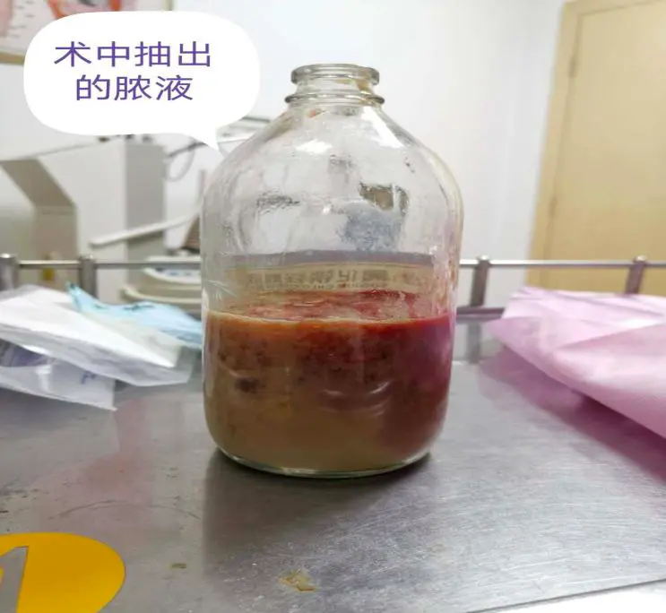 附件囊肿穿刺引流多久 囊肿引流出多久