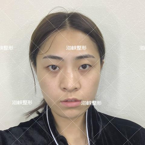 济南割双眼皮哪家好相关长尾关键词有哪些