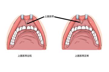 【天津儿童唇系带】长尾关键词有什么