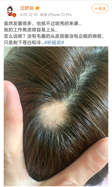 沈梦辰自爆斑秃是怎么回事