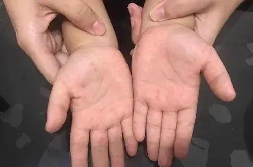 孩子手足口病高发怎么预防