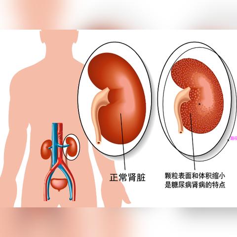 天津肾病看哪个