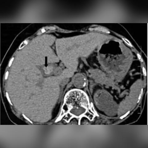 鼻息肉广州相关长尾关键词有哪些