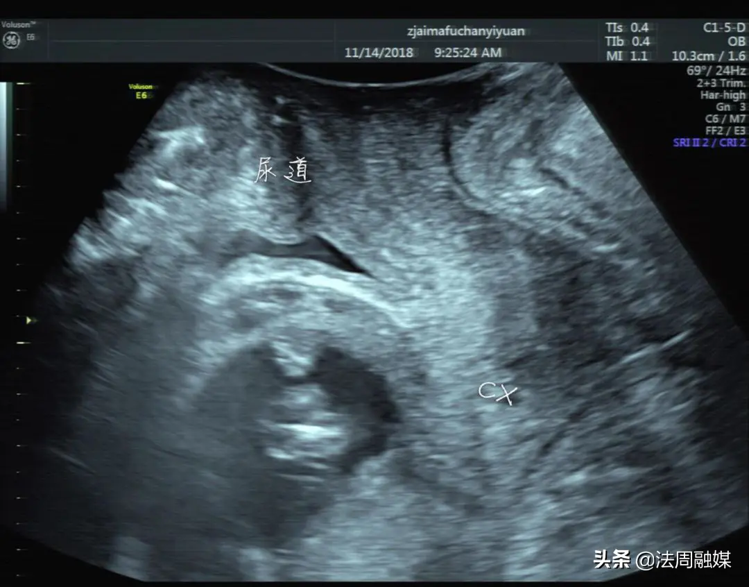 接引流是什么 怎么直接引流