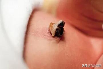 护理新生儿脐带