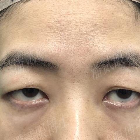 广州市双眼皮多少钱