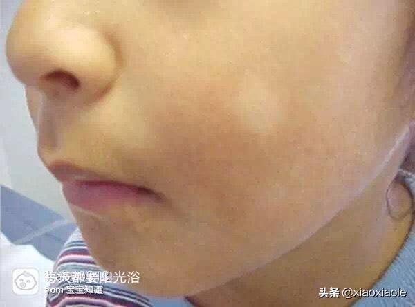 孩子长虫斑怎么办