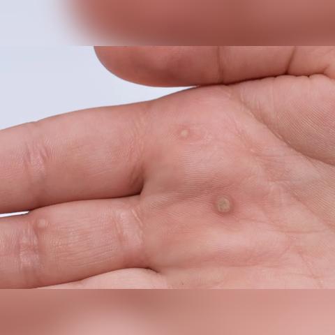 颈部皮肤病图片大全的长尾关键词有什么