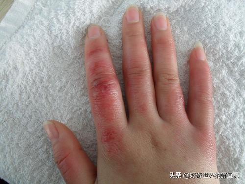儿童皮肤皲裂的原因