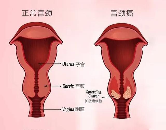 妊娠期宫颈癌和非孕期一样吗